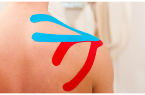 Physiotherapy kinesio taping, dry needling, Physiotherpy in chichester, James Silk, Physiotherapy, physiotherapist, physio, rehab, injury, massage, soft tissue, Chichester Chiropractic Health Centre, Chiropractor, Chiropractic, Chiropractor near me, chiropractic near me, chiro, back pain, Sciatica, Neck Pain, Chiropractor, Chiropractic, click, crack, crunch, grind, ache, sharp, stabbing, burning, chichester, west sussex, hayling, bognor, emsworth, fishbourne, arundel, westergate, eastergate